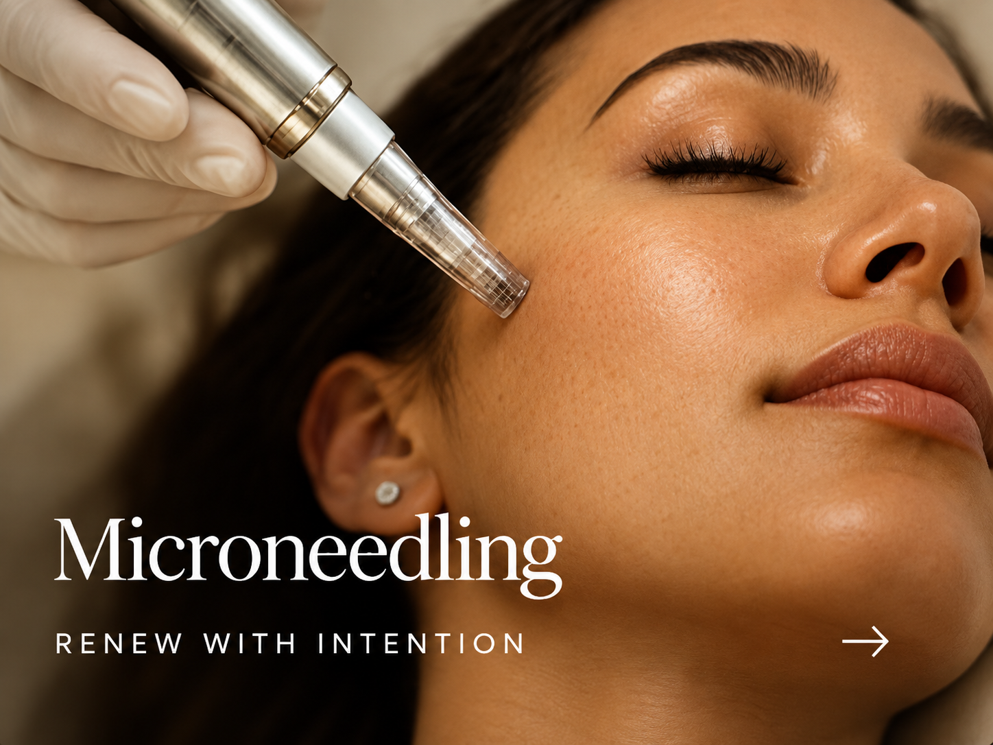 Microneedling — Renew with Intention